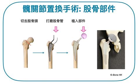 骨枯手術費用|【髖關節手術】即睇原理、副作用及詳細步驟+收費參。